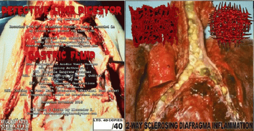 Gastric Fluid : 2-Way Sclerosing Diafragma Inflammation